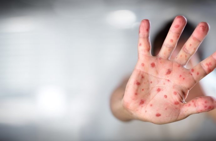 Artan Kızamık Vakalarına  Dikkat !